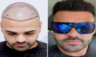 The World's Preferred Hair Transplant Center Turkey