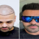 The World's Preferred Hair Transplant Center Turkey