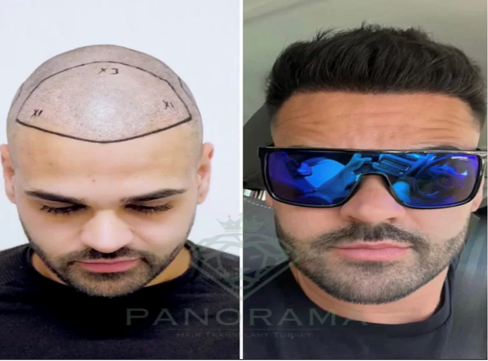 The World's Preferred Hair Transplant Center Turkey