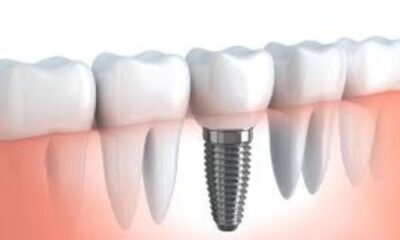 Why Dental Implants Are a Smart Investment for Long-Term Oral Health