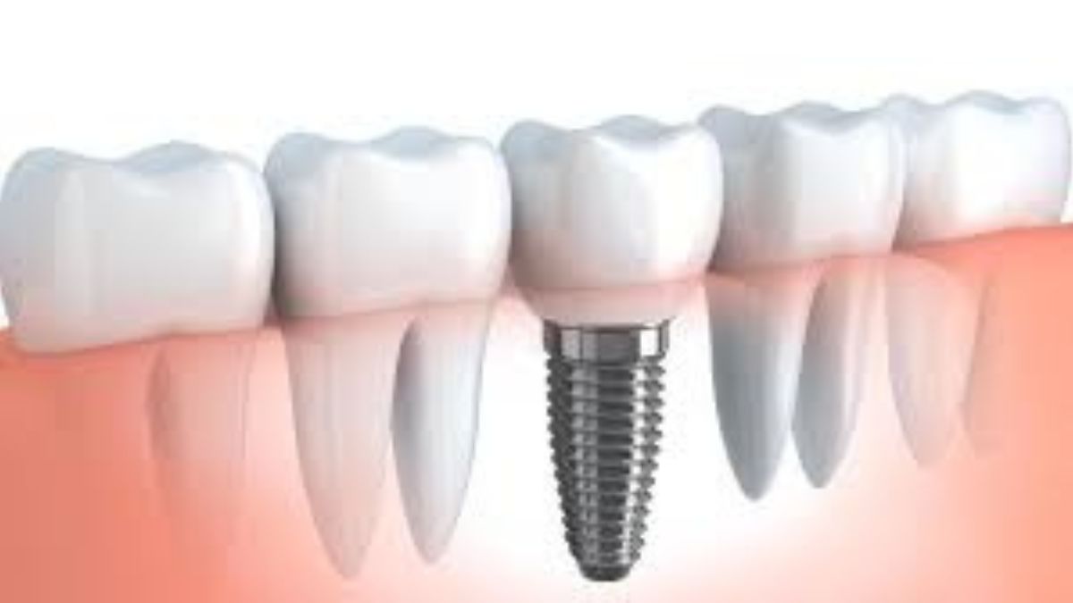 Why Dental Implants Are a Smart Investment for Long-Term Oral Health